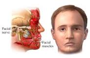 Porażenie nerwu twarzowego (VII n. czaszkowy)